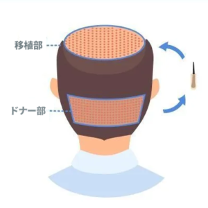 トルコ　植毛